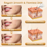 Skin Tag & Wart Removal Pen 9-Level Electric Remover Tool Kit w/ 5 Disposable Needles Reusable 39936682